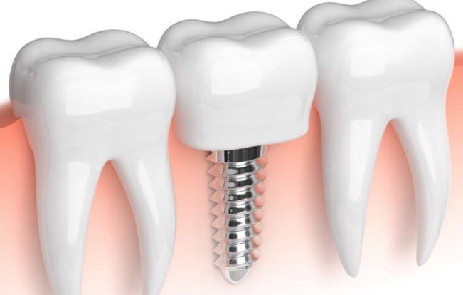 diş implantları nasıl yapılır