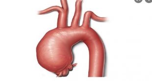 aort damar neden yırtılır